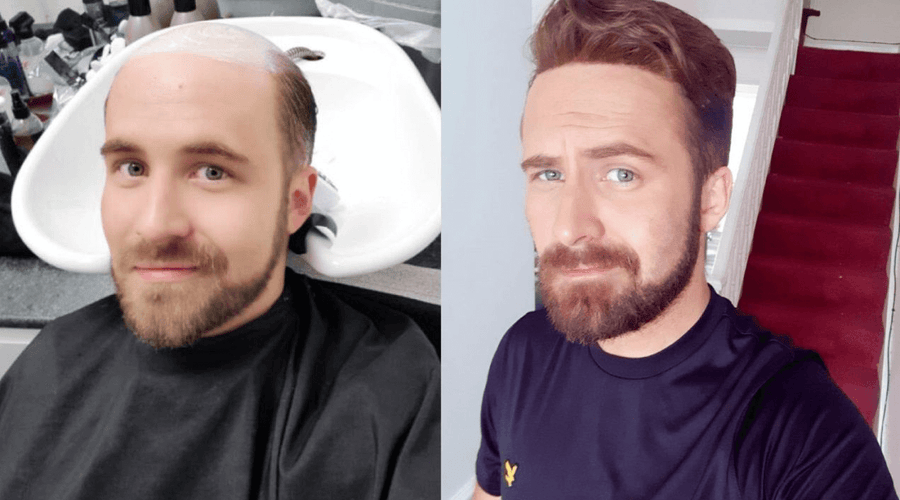 Why Choose Non-Surgical Men's Hair Replacement Systems Instead of Surgical Ones?