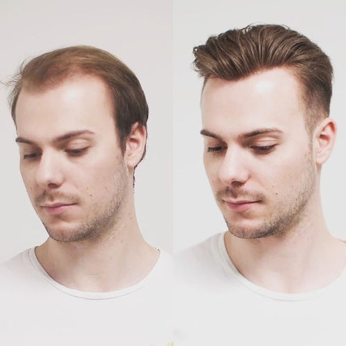Why do you need non-surgical hair replacement California: 5 Reasons?