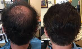 What are Pharmaceutical Hair Replacement System Options?
